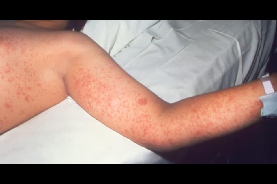 A patient infected with measles. (Interior Health photo)
