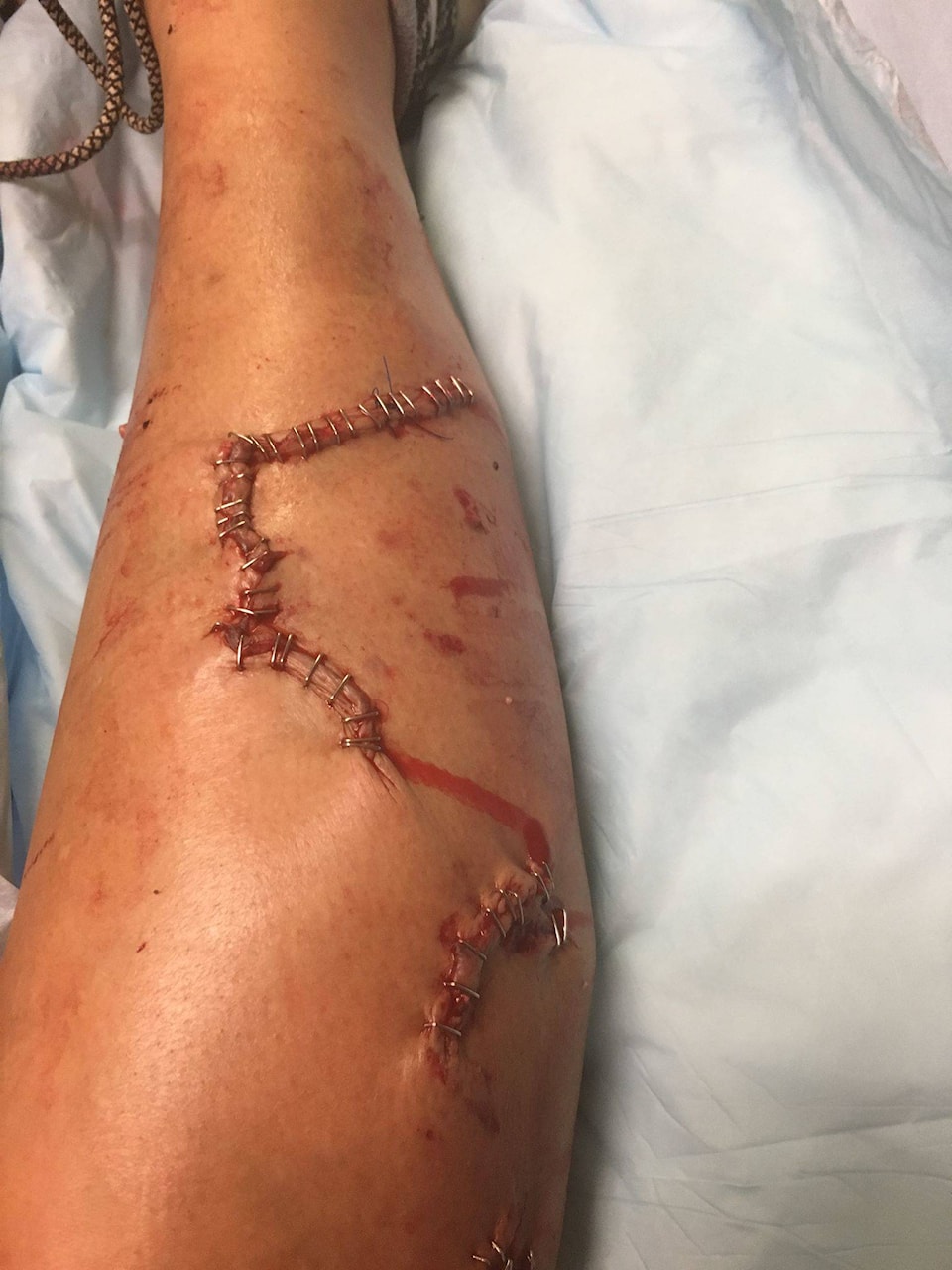 11835825_web1_Dog-bites-leg-staples