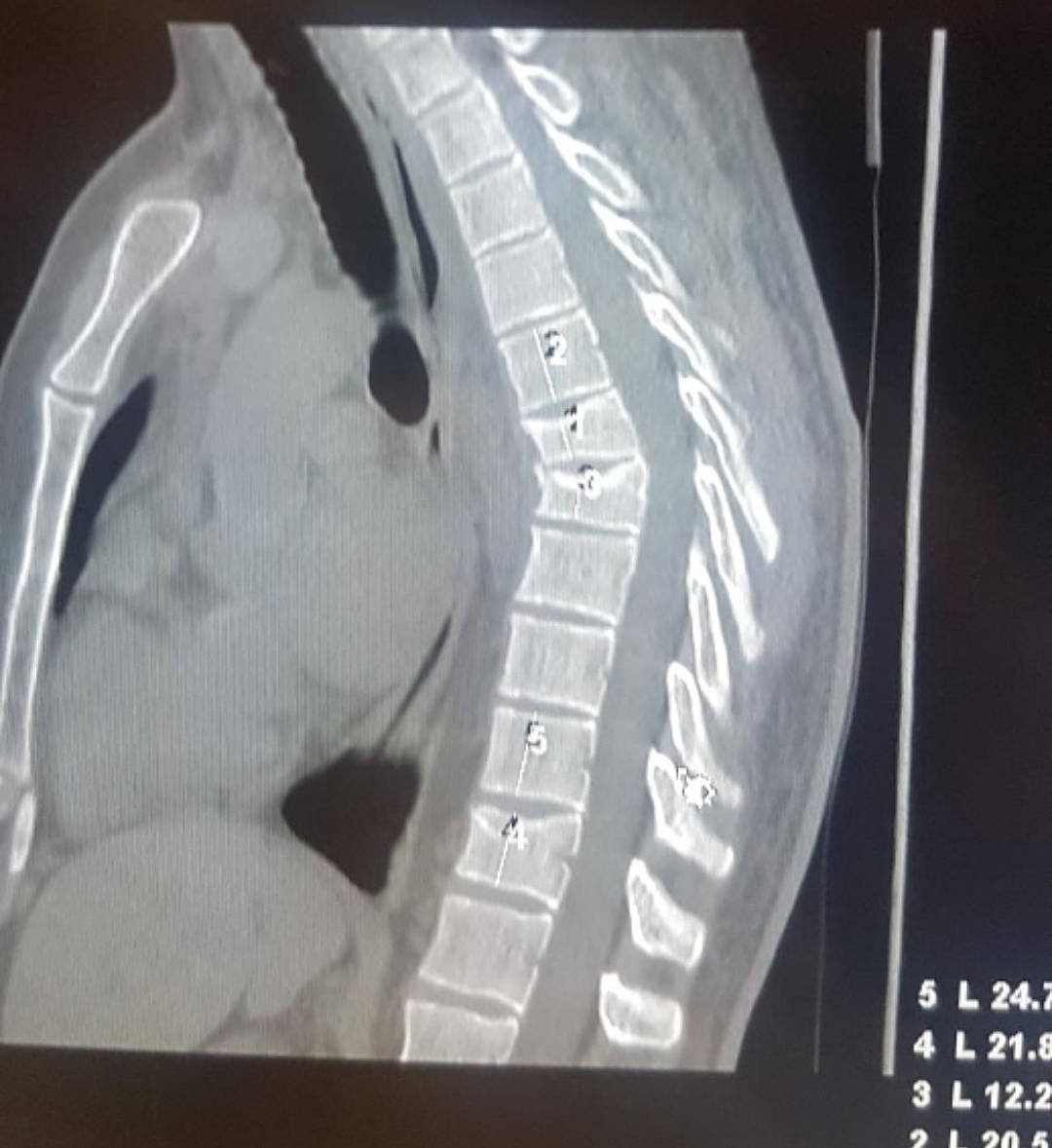 B.C. mountain biker sent home from hospital twice despite broken