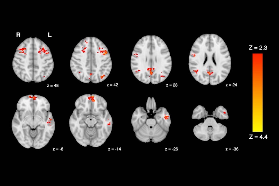 31674534_web1_230124-SNE-UVicTrafficPollutionStudy-brainscan_1