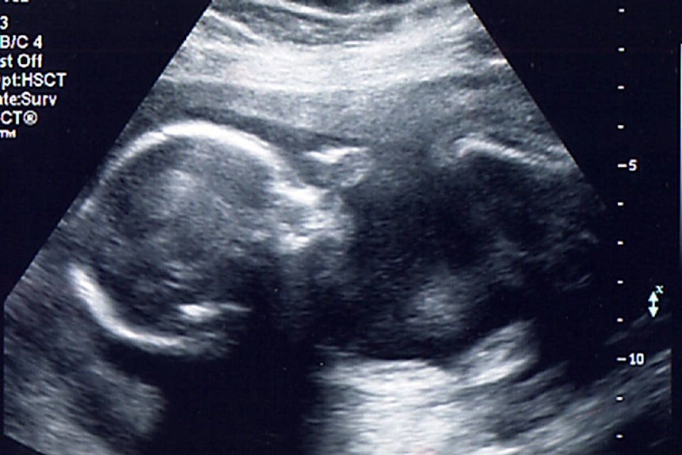 15957590_web1_Baby-sonogram