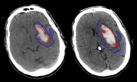 70229surreystroke_ct_haemorrhage_02