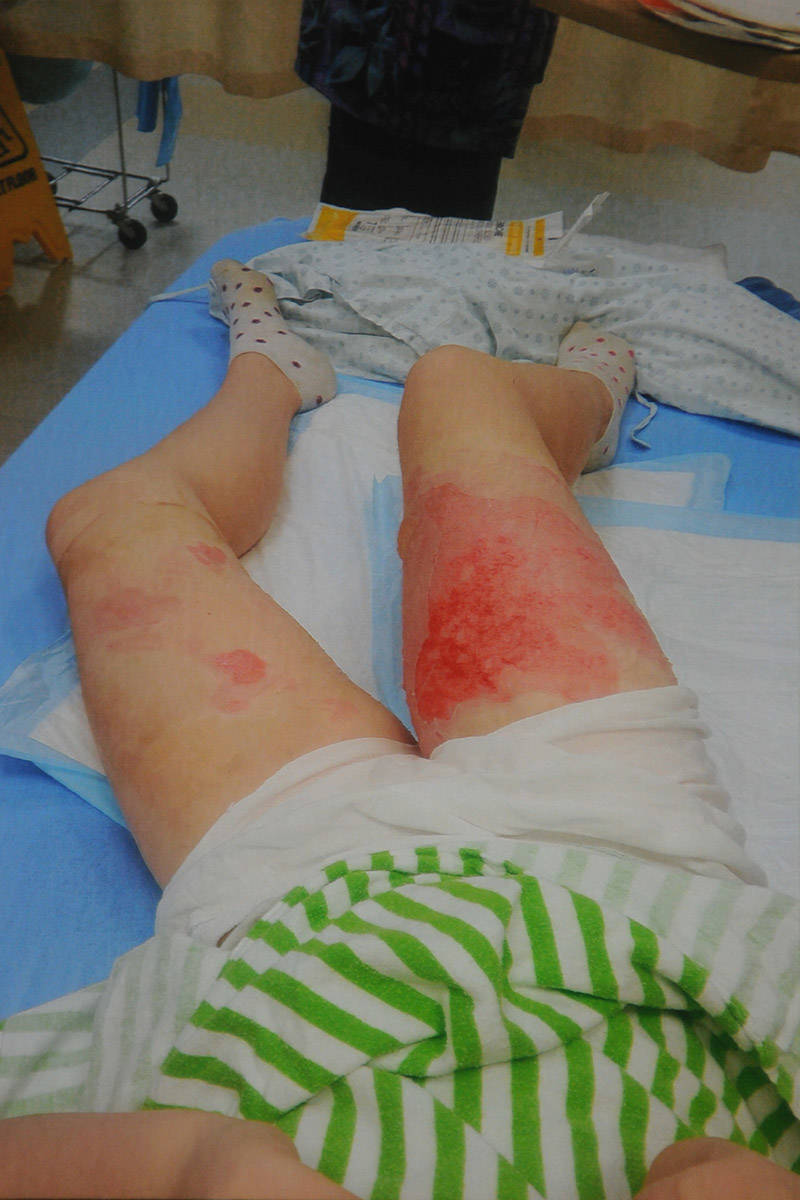 Keira McKenzies legs on the day she was burned by scalding hot tea, coffee and hot chocolate. (Submitted)