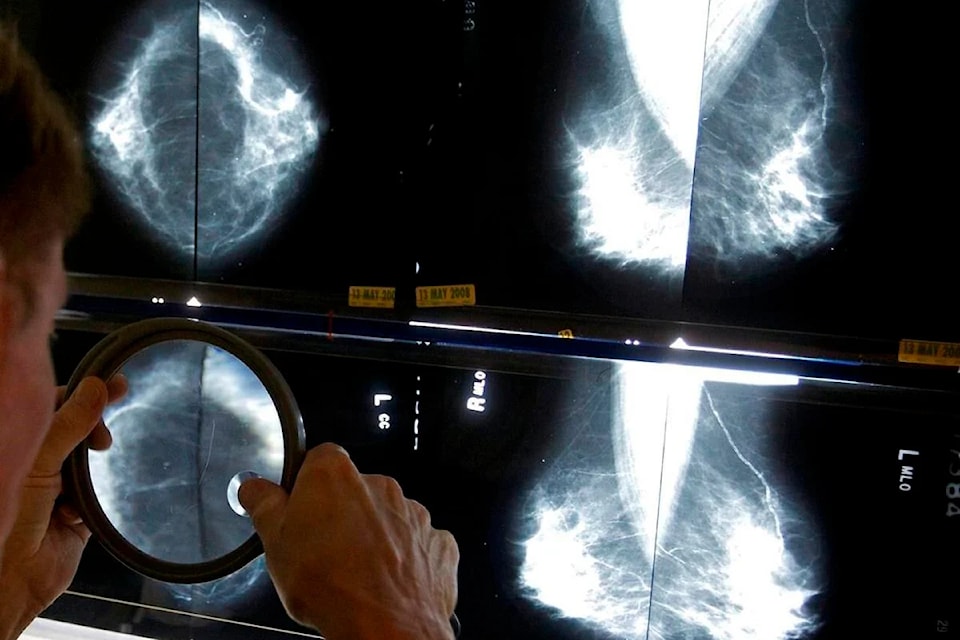 In this 2010 file photo, a radiologist uses a magnifying glass to check mammograms for breast cancer in Los Angeles. The Canadian Cancer Society says all provinces and territories should lower the starting age for breast cancer screening to 40. 
