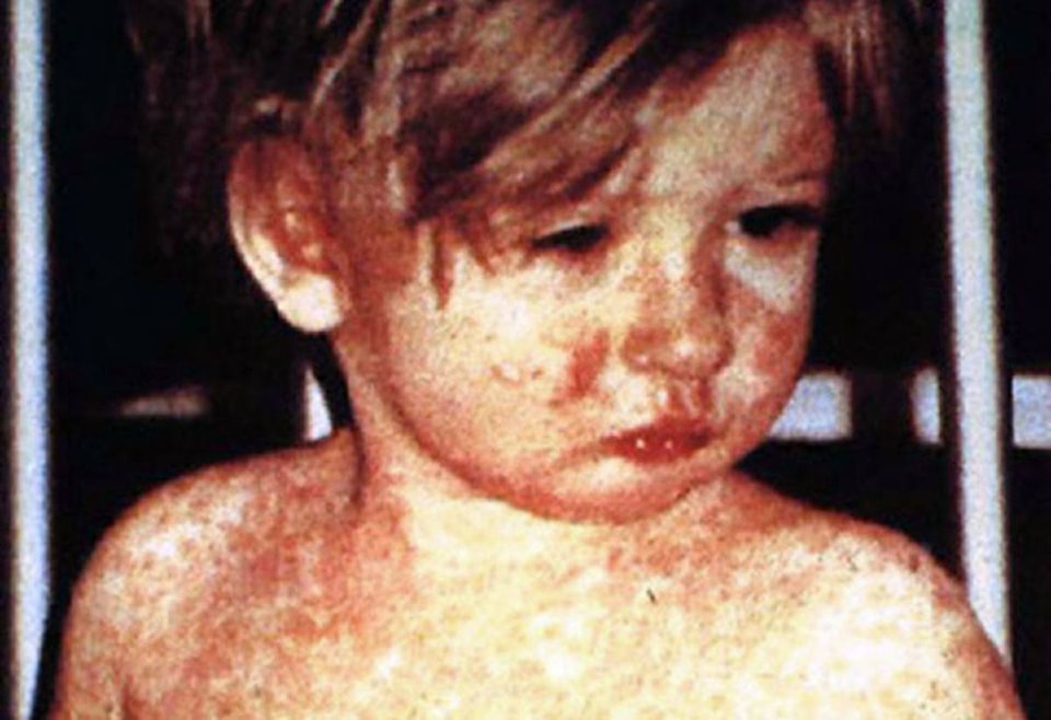 15299415_web1_measles