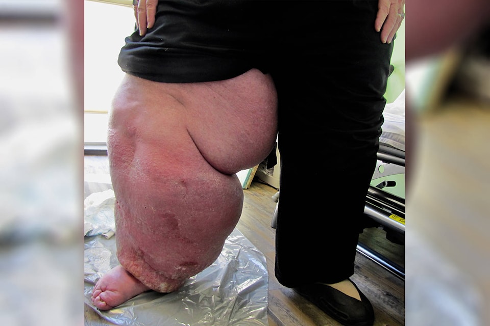 24382555_web1_210303-CVR-N-Lymphedema-1_1