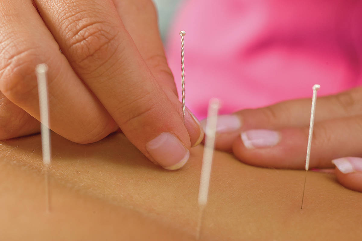 Acupuncture and all it has to offer you
