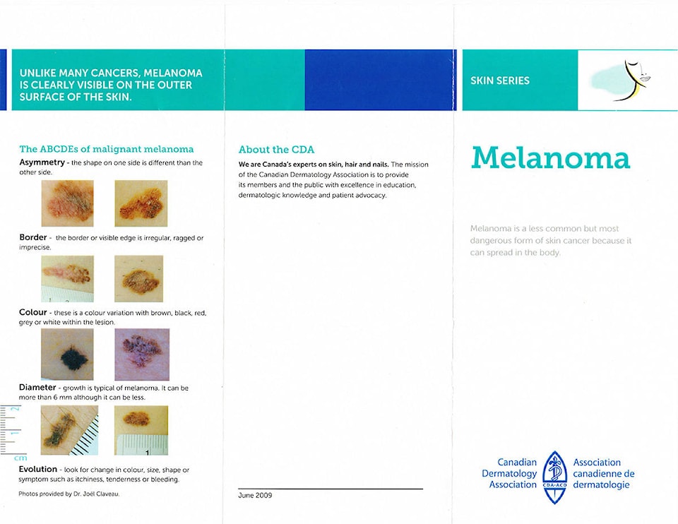 web1_melanoma
