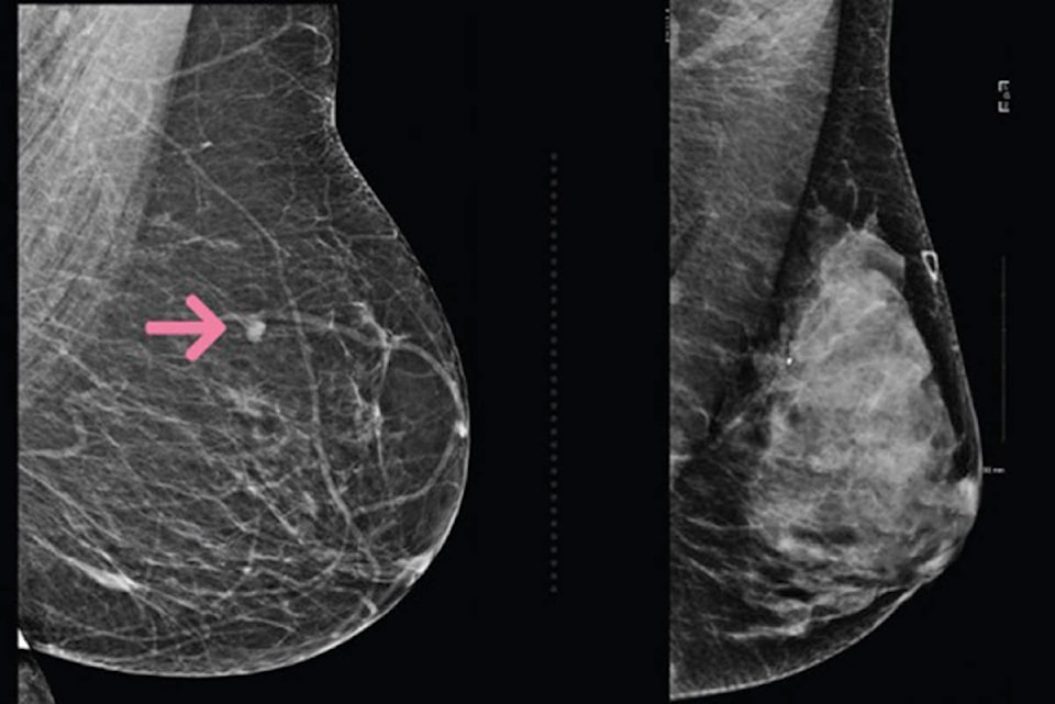 13654655_web1_breast-density