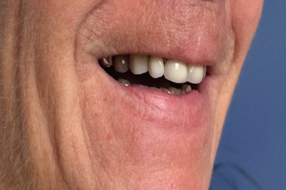 19344843_web1_Perfit-Dental-Solutions-Flipper-Denture