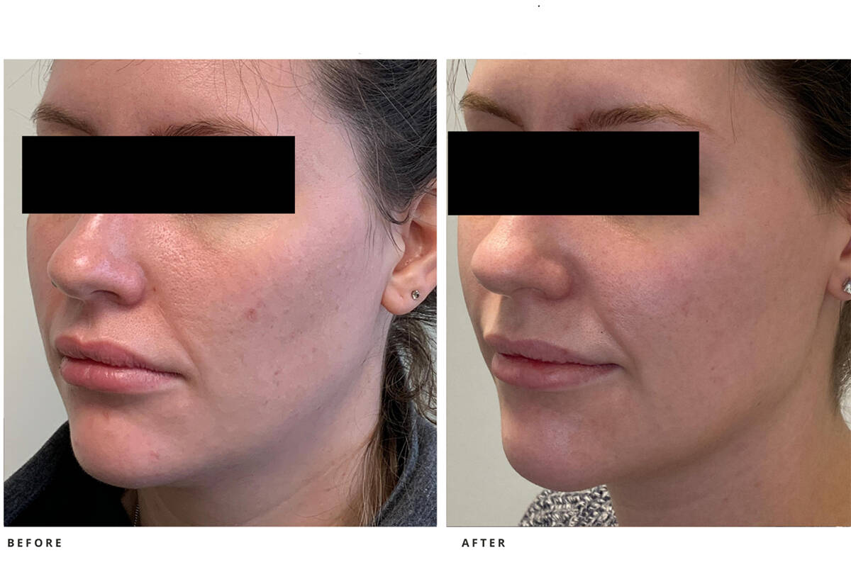 Filler for chin and jawline can make a noticeable difference.
