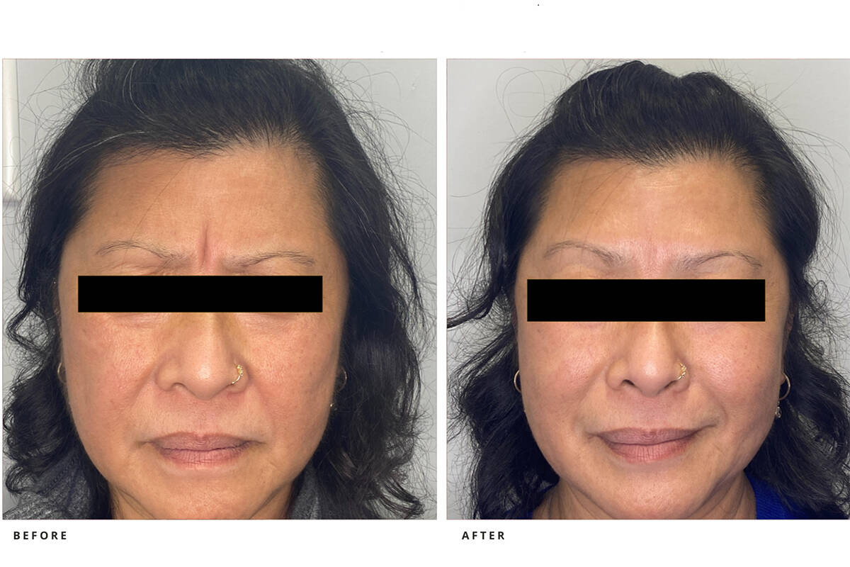 Neuromodualtor (Botox) for frown and forehead.