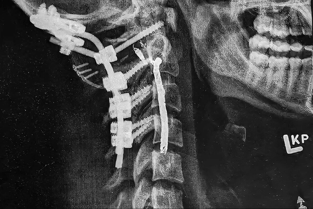 AT 22, Aldergroves Sydney Stenburg broke her neck, the result of the damage done by a tumour, and required surgery to implant supports to her spinal column. (Special to Langley Advance Times)