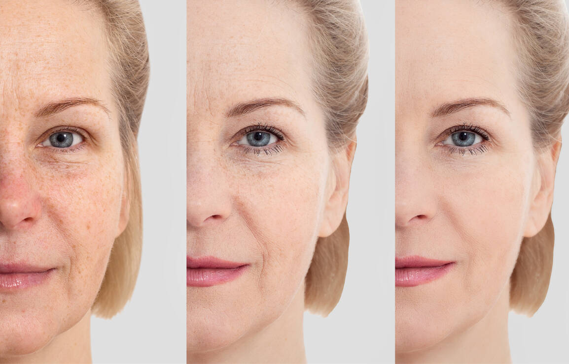 Botox is an effective way to keep lines at bay 聴 and is best administered by a certified professional.