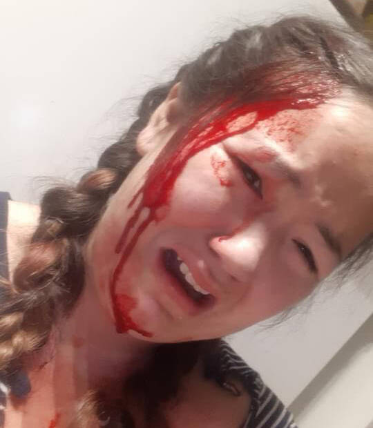 Alysha Archie after a violent assault by her ex-partner Keith Cailing on Oct. 5, 2021. Cailing was sentenced to 22 days jail for this assault that cause a significant head injury. (Submitted by Alysha Archie)
