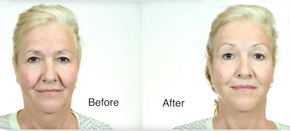 11654241_web1_OxyLift-Before-After