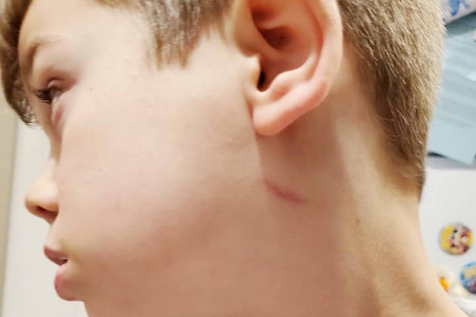 A scratch was visible on Bryson Belmas’ neck after an incident at school. (Special to The News)
