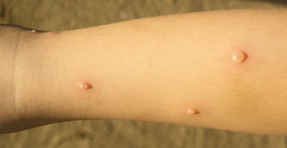 34722582_web1_231201-YEL-Chickenpox-Image_1