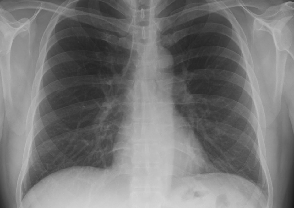 chest_xray_pa_3-8-2010