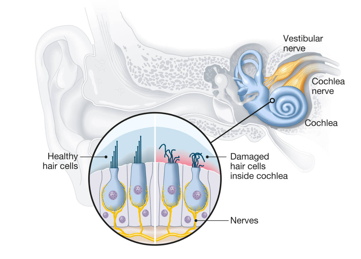 Healthy and damaged hair cells inside cochlea.