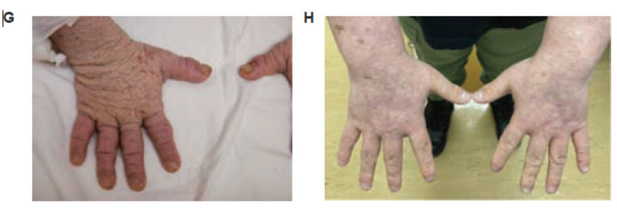 On the left: Jesses hands before starting treatment. On the right: dramatic improvement after starting treatment (Photo and caption provided by B.C. Childrens Hospital)