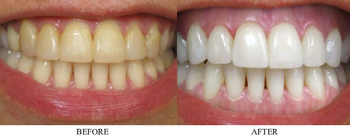 Teeth whitening treatments at Simply White Dental will give you the confidence to show your sparkle!