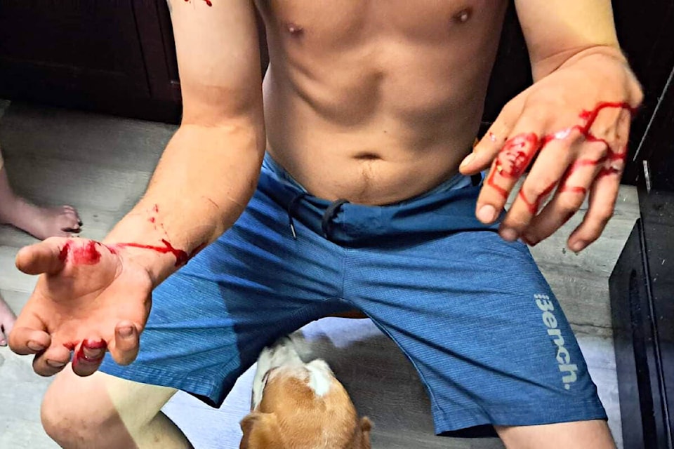 Joel Anstett, with his dog Apollo, shows some of the injuries he suffered while fighting off a bobcat that was attacking Apollo in the back yard of their Ashcroft home on July 20. (Photo credit: Submitted)