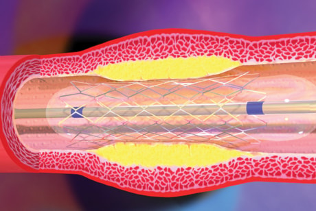 B08-angioplasty