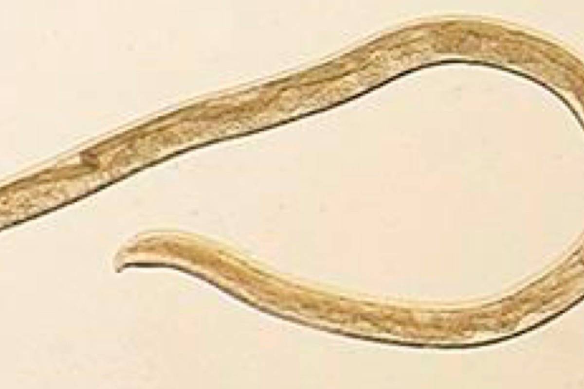 14 worms pulled from woman's eye after rare infection - Red Deer