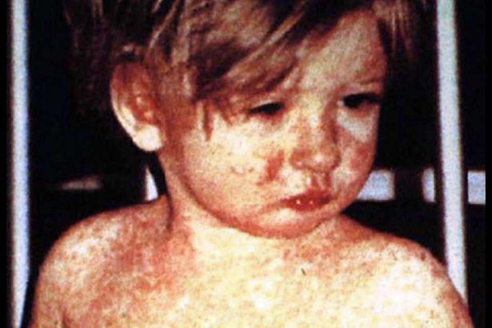 15711766_web1_190226-RDA-Measles-unlikely-to-spread-but-everyone-should-be-vaccinated-Vancouver-doctor_1