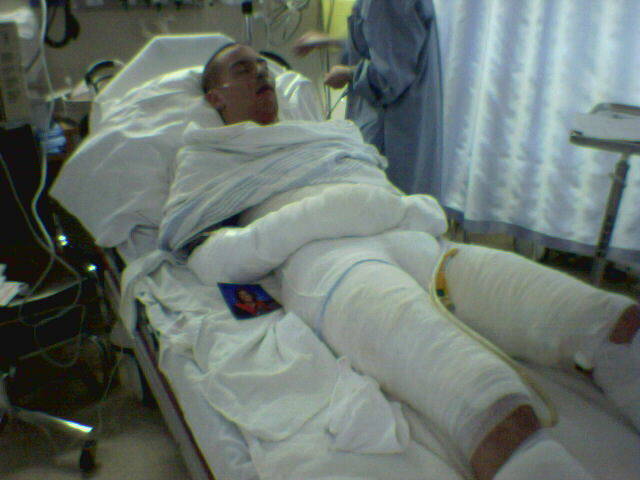 Aaron Volpatti spent nearly six weeks in the Vancouver General Hospital Burn Unit following an accident in Vernon that left him with third and second degree burns on 40 per cent of his body. (Contributed by Aaron Volpatti)