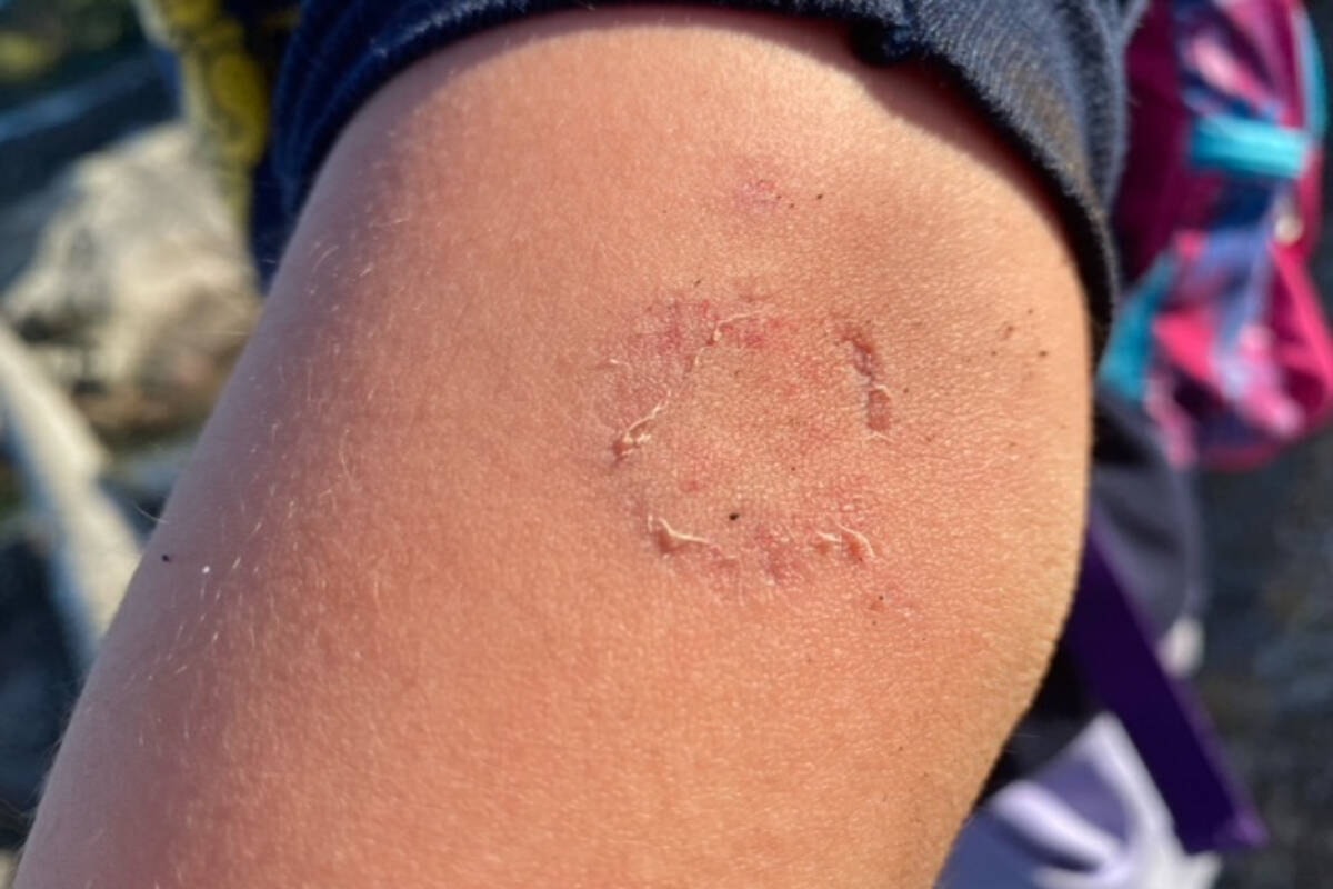 Dog clearance bite pictures