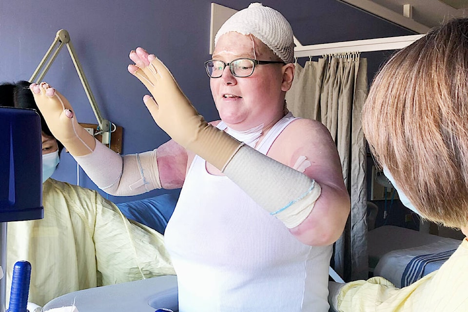 Devonne received burns to 63 per cent of her body following a car fire. (Special to The News) 