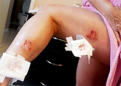 Cloverdale woman recovering from terrifying otter attack