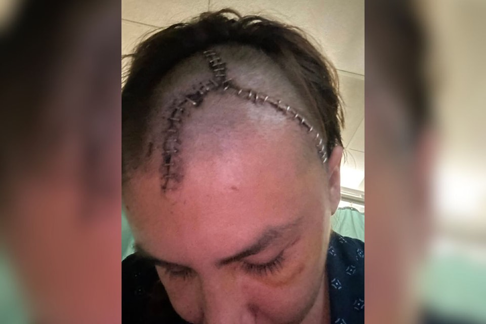 Vernon's Kianna Lacroix shows some of the physical scars received in a head-on vehicle collision with a semi truck June 22. A beach party to raise funds for Lacroix's continued recovery from the crash will be held this Saturday, July 19, from 12-4 p.m. at Paddlewheel Park in Okanagan Landing.