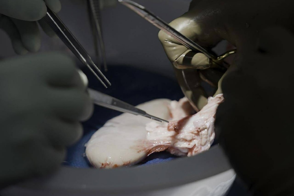 Le rein de porc fonctionne dans le corps du donneur, marquant une étape vers les greffes animales-humaines