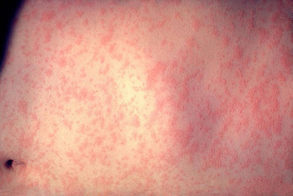 15575358_web1_800px-Morbillivirus_measles_infection