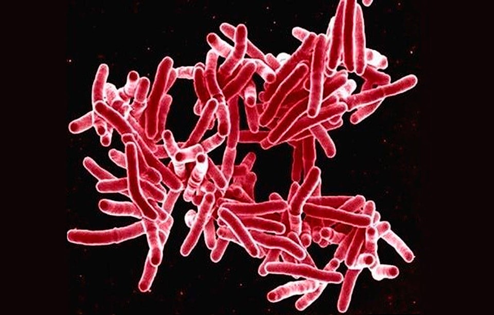 16264731_web1_tuberculosis-M